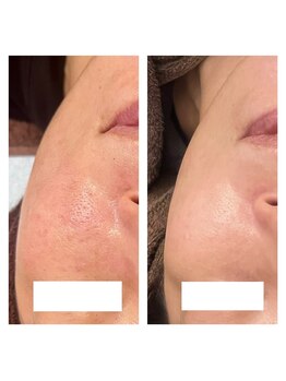 ヴィヴ コレビ(VIV COREBI)/たるみによる毛穴ケア