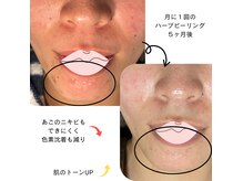ぷなけあ(Punakea)の雰囲気（幹細胞×有機ハーブピーリング☆ニキビケアやくすみに◎）