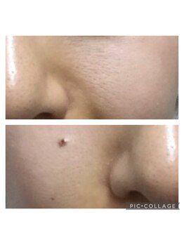 インナーエステ専門店　INNE【イネレ】/ビフォーアフター