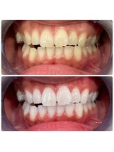 エクシアホワイトニング 日本橋店/茅場町ホワイトニング