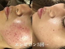 シュリー(Sriii)の雰囲気（エンビロンの乳酸/ビタミンAケアは毛穴トラブルの根本改善に◎）