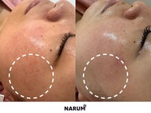 ナルムフェイシャル 代々木(NARUM facial)の雰囲気（繰り返すニキビ・毛穴詰まり、増えるシミを終わらせる）