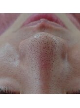 サロンエム(Salon m)/鼻　毛穴つまり