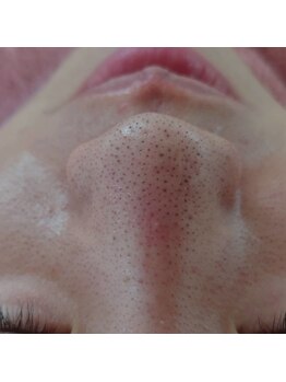 サロンエム(Salon m)/鼻　毛穴つまり