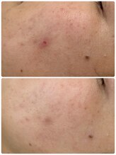 アンド ユー(and.yu)/シミケア・美肌コース4回