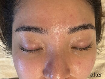 サロン ド エメ(salon de aimer)/【After】赤み改善、毛穴縮小