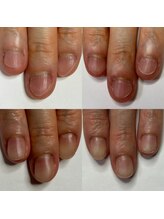 マニュコクーン(ManuCocoon)/爪育成　深爪　巻き爪　大阪市