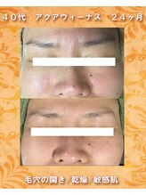 ナイア(naia)/毛穴ケア＆アクアヴィーナス