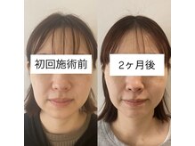 リアプア(Li'a)/【２ヵ月変化】たるみ/肌質改善