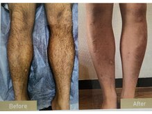 クローバー(clover)/足脱毛