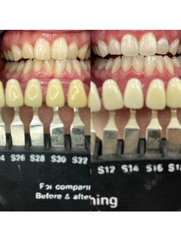 トウキョースワーズ 渋谷店(TOKYO SWRS)/#ホワイトニング #渋谷 #池袋