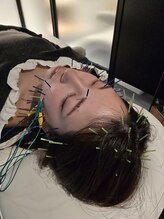 チョコバリ 渋谷店(chocobari)/小顔×リフトアップ(美容鍼)20代