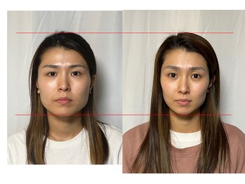 美容整体 アルマ/小顔矯正10回目