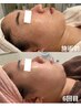 【肌の土台から整える】剥離なし×毛穴×ニキビケア艶肌ハーブピーリング90分