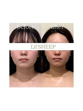 リルシープ(LIL'SHEEP)/眠れる小顔コルギ３回施術