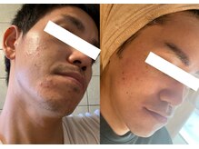 ルポ 那覇(repos)/電気美容鍼