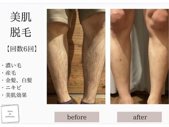 サロン ド パーフェクション(Salon de Perfection)/脱毛