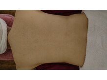 サロンエム(Salon m)/背中ニキビケア