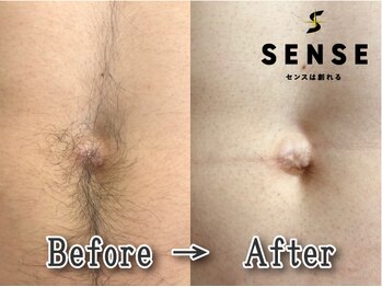 センス 八戸城下(SENSE)/気になるお腹もスッキリ脱毛！