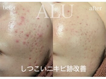 アルフォービューティー 恵比寿店(ALU for beauty)/ニキビ症例