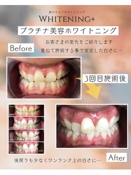 ホワイトニングプラス(Whitening+)/プラチナ美容ホワイトニング