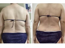 ブリリアント(Brilliant)/背中二の腕