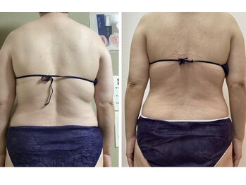 ブリリアント(Brilliant)/背中二の腕