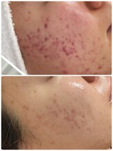 ルアナライフ(Luana Life)/HARIで肌荒れ改善