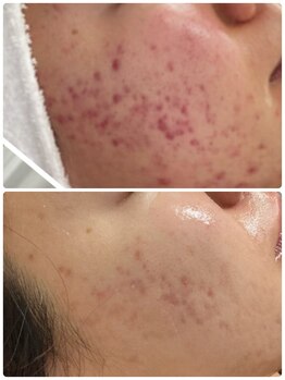 ルアナライフ(Luana Life)/HARIで肌荒れ改善