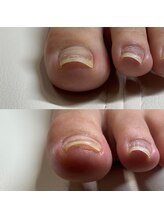 リリ(lili)/巻き爪矯正2回目（左親指）