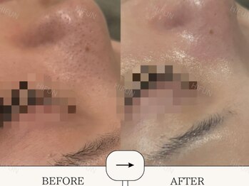 ハイフン(HIFUN)/ララピール*シミケア/毛穴洗浄