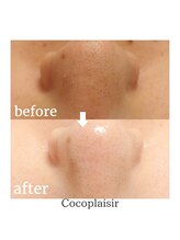 ココプレジール(Cocoplaisir)/フェイシャル/毛穴/ブツブツ