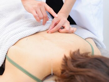 鍼灸イズンの写真/＜電気美容鍼×からだの鍼＞で健康的に美しく*お顔のエラ/噛みしめが気になる方にも◎岐阜駅すぐ/完全個室