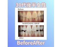 ホワイトニングショップ 西原店/30代後半女性☆BeforeAfter