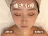 肩こり解消!小顔サーマリフト!新規¥8,000/再来¥13,000