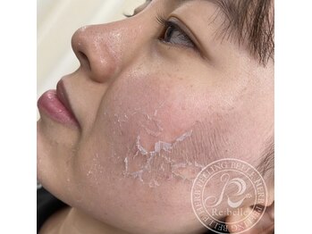 ハーバリー ハーブピーリング 岐阜(HERBERRYハーブピーリング)/ハーブピーリング専門店HERBERRY