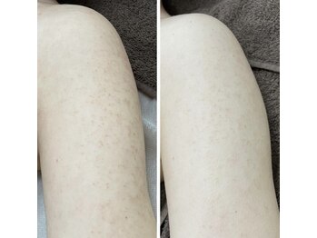 カルディエ(Cardie)/BODYハーブピーリング