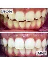 LBSホワイトニング 上野店/ホワイトニングビフォーアフター