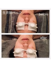 ゲッカ(GEKKA)/ヒト幹細胞生炭酸パック