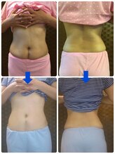 ディープブルー(Deep blue)/痩身キャビテーション