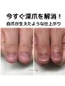 【男性/深爪矯正/体験】まるで爪が生えた自然な仕上がり￥31900→