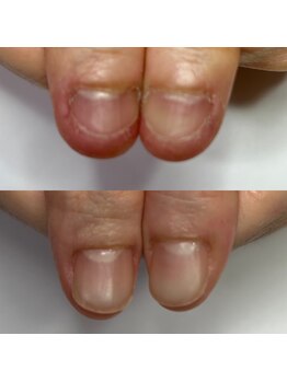 マニュコクーン(ManuCocoon)/爪育成 深爪 巻き爪 大阪市