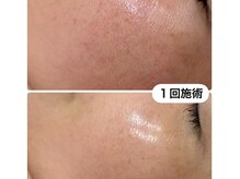 お肌が変わるレチノール♪ニキビケア、ツヤ毛穴ケアに！