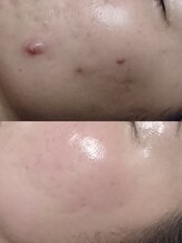 ソリッジ肌管理室/本気のニキビケア