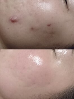 ソリッジ肌管理室/本気のニキビケア