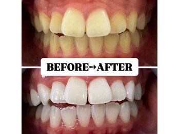 ホワイトニングサロン 豊中/Before&After美白ホワイトニング