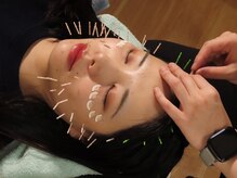 ヘッドスパ付きのうれしい特典あり！美容鍼×ヘッドで小顔効果◎