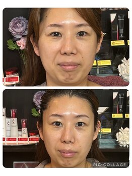 ルピナージュ(Lupinage)/小顔フェイシャル