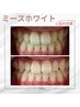 【ご紹介のお客様】セルフホワイトニング　¥0