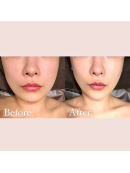 レプス(Lepus)/テスラセラピー(リフトアップ)